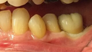 Bill - Dental Implants after