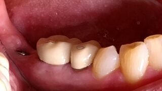 Tom - Dental Implants before