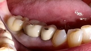 Tom - Dental Implants after