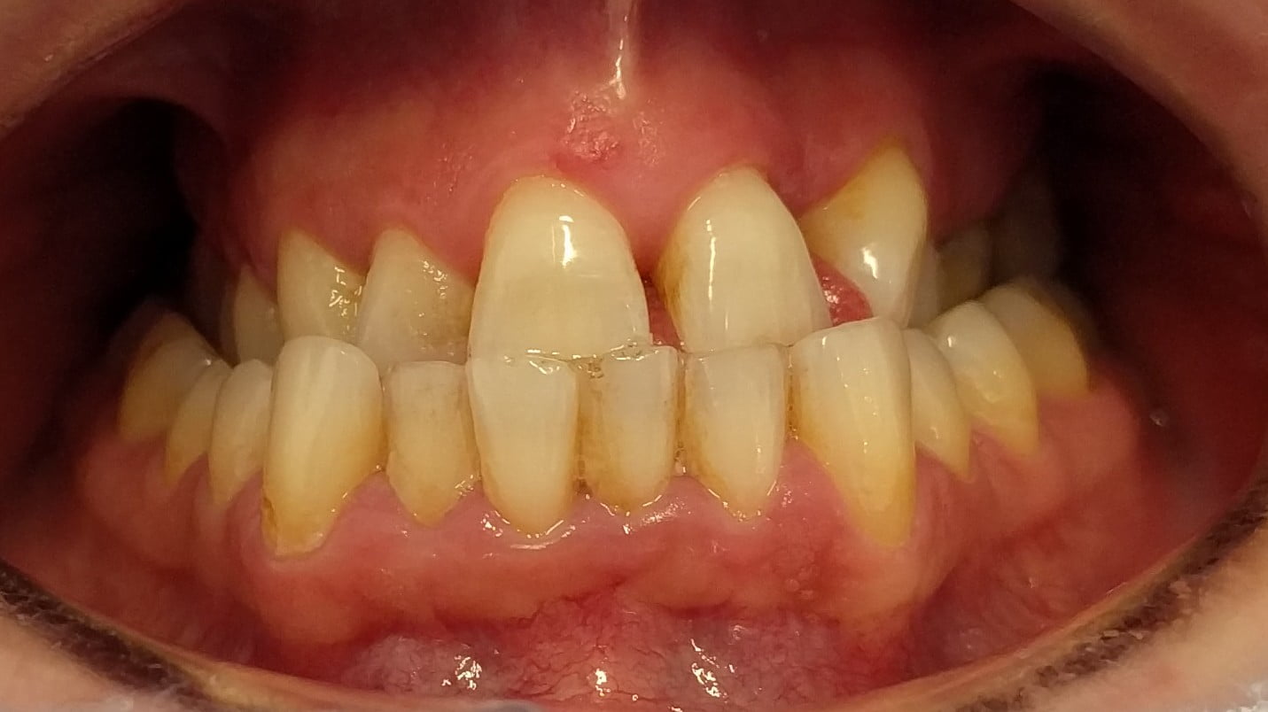 Carly - Porcelain Crowns, Porcelain Veneers, Teeth Whitening before