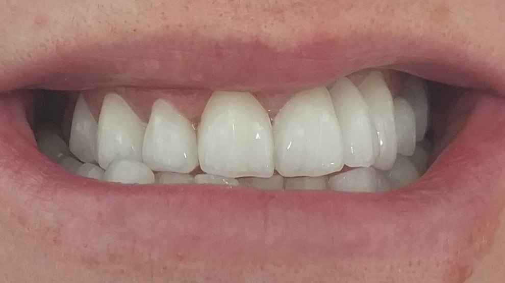 Carly - Porcelain Crowns, Porcelain Veneers, Teeth Whitening after