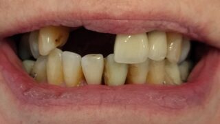 Carole - Dental Implants before