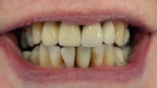Carole - Dental Implants after