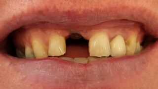 John - Dental Implants before