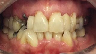 Moira - Dental Implants, Porcelain Crowns before