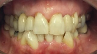 Moira - Dental Implants, Porcelain Crowns after
