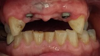 Jack - Dental Implants before