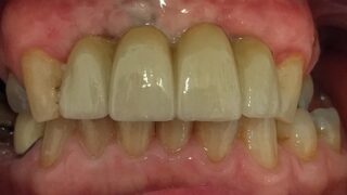 Jack - Dental Implants after
