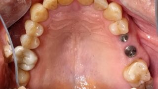 Hamish - Dental Implants before