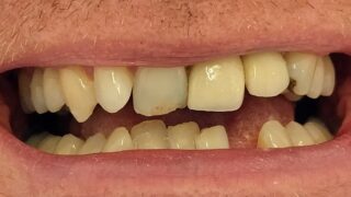 Adrian - Dental Implants, Porcelain Veneers before