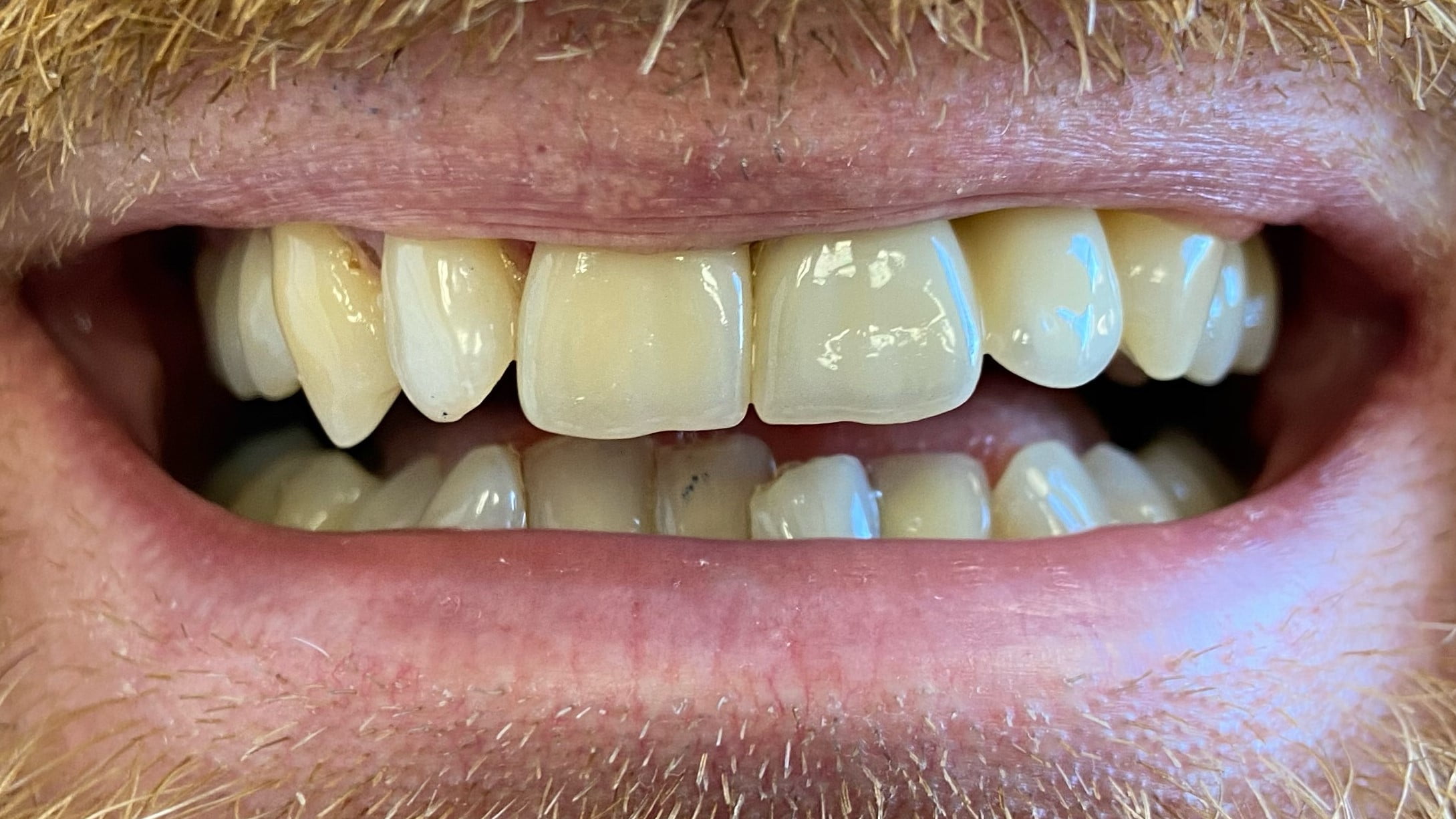 Adrian - Dental Implants, Porcelain Veneers after
