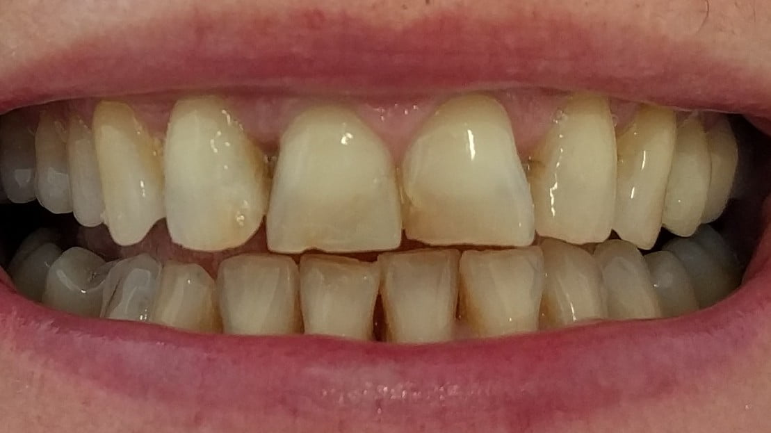 Caroline - Porcelain Veneers, Teeth Whitening before