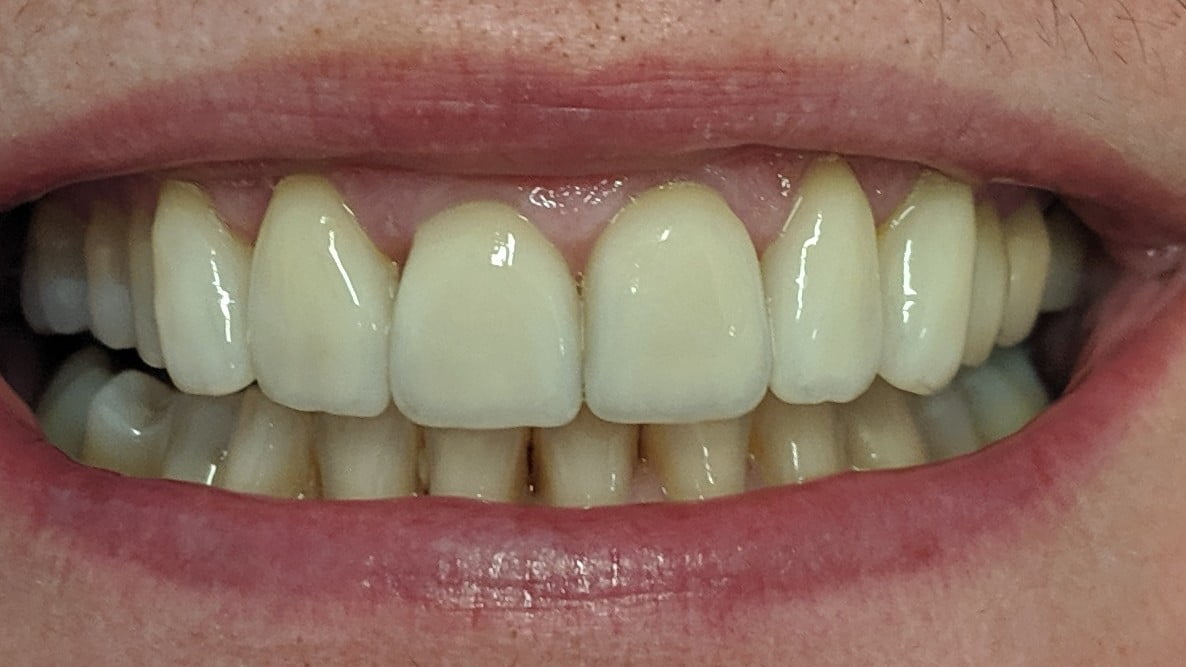 Caroline - Porcelain Veneers, Teeth Whitening after