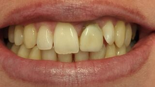 Katie - Dental Implants before