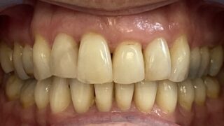 Pam - Invisalign after