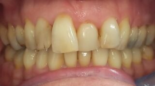 Pam - Invisalign before