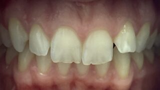 Nadia - Invisalign, Composite Bonding before