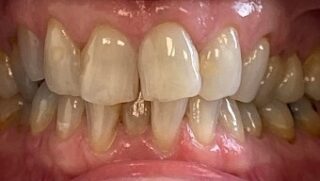 Janice - Invisalign before