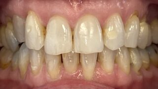 Janice - Invisalign after