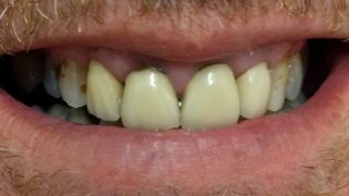 Phil - Dental Implants, Porcelain Crowns before