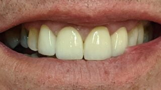 Phil - Dental Implants, Porcelain Crowns after