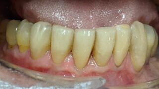 Charles - Porcelain Crowns, Composite Bonding after