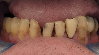 Charles - Porcelain Crowns, Composite Bonding before