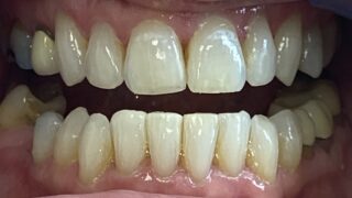 Marion - Invisalign after