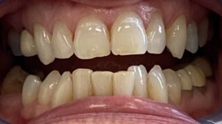 Marion - Invisalign before