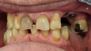 Tony - Dental Implants before