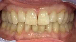 Charlotte - Invisalign, Composite Bonding after