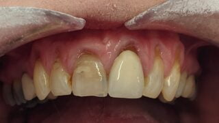 Carla - Porcelain Crowns, Teeth Whitening before