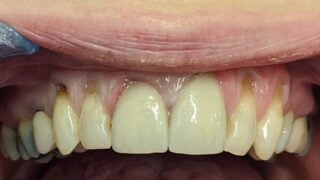 Carla - Porcelain Crowns, Teeth Whitening after