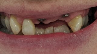 Christine - Dental Implants before