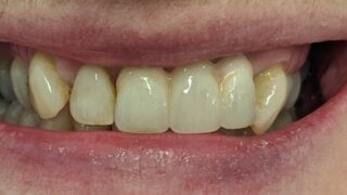Christine - Dental Implants after