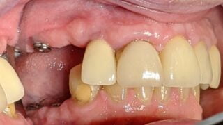 Caroline - Dental Implants before