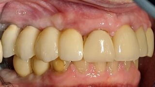 Caroline - Dental Implants after