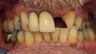 Adam - Porcelain Crowns before