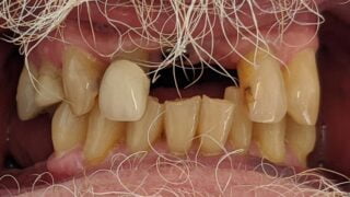Stan - Dental Implants before
