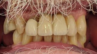 Stan - Dental Implants after