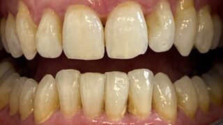 Andrea - Invisalign after