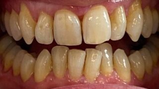 Andrea - Invisalign before