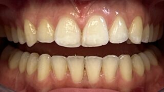 Helena - Invisalign, Composite Bonding, Teeth Whitening after