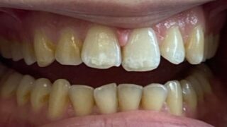 Helena - Invisalign, Composite Bonding, Teeth Whitening before