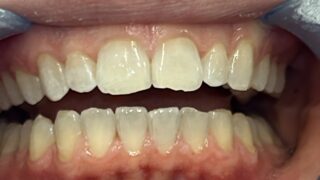 Lydia - Invisalign after