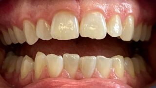 Lydia - Invisalign before